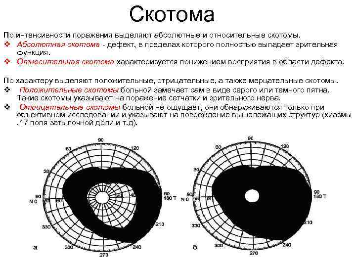 Скотома По интенсивности поражения выделяют абсолютные и относительные скотомы. v Абсолютная скотома - дефект,