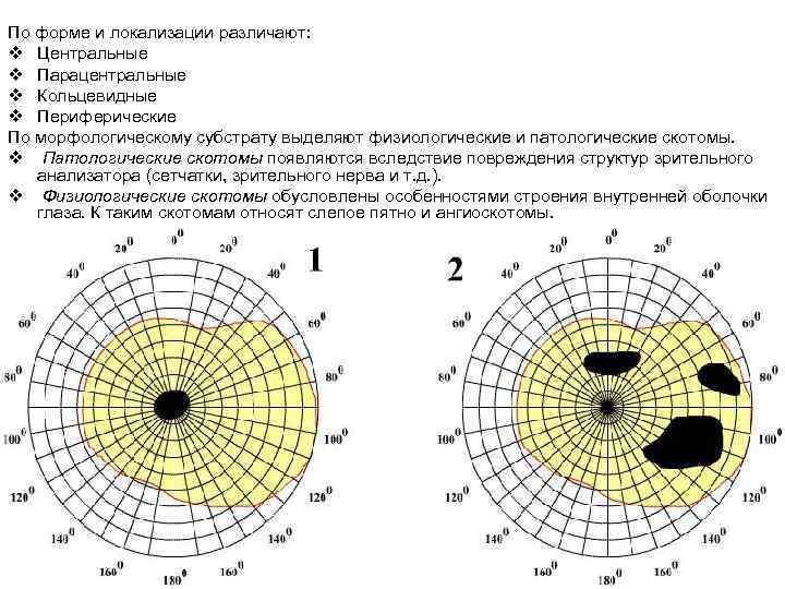 По форме и локализации различают: v Центральные v Парацентральные v Кольцевидные v Периферические По