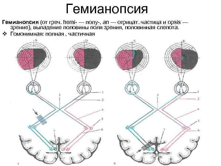 Гемианопсия (от греч. hemi- — полу-, an — отрицат. частица и opsis — зрение),