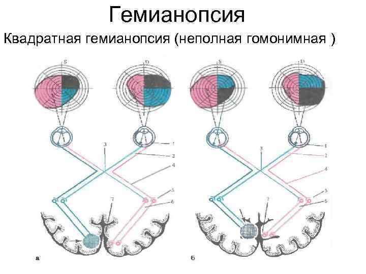 Гемианопсия Квадратная гемианопсия (неполная гомонимная ) 