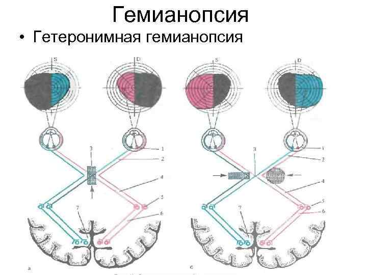 Гемианопсия • Гетеронимная гемианопсия 