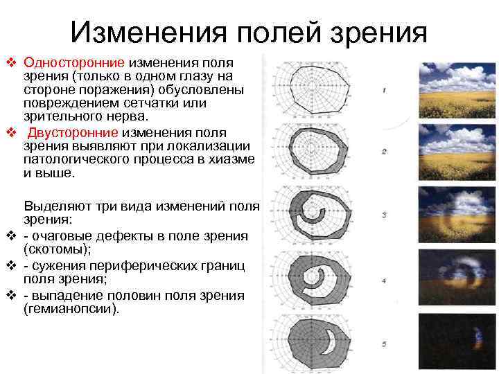 Изменения полей зрения v Односторонние изменения поля зрения (только в одном глазу на стороне