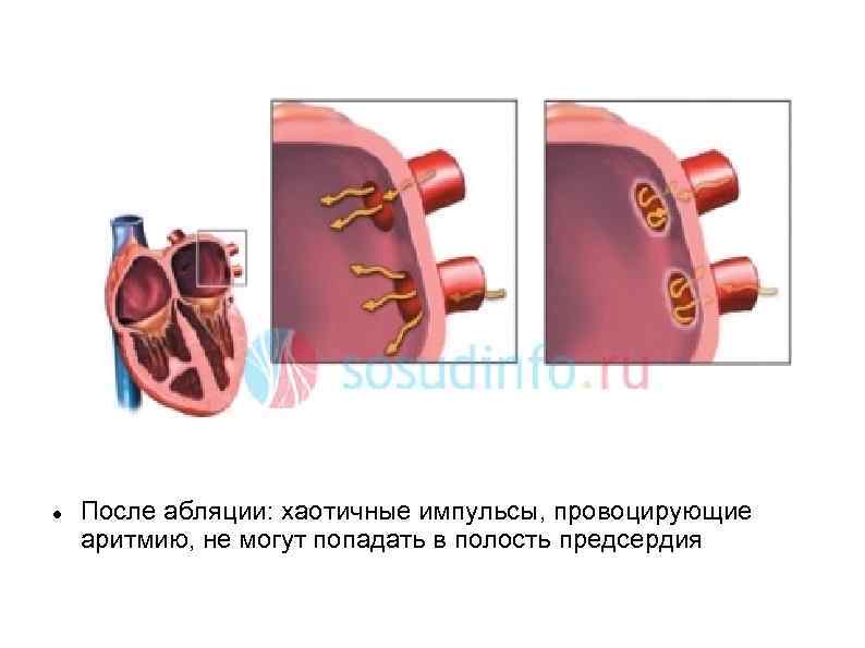  После абляции: хаотичные импульсы, провоцирующие аритмию, не могут попадать в полость предсердия 