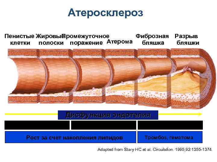 Атеросклероз Пенистые Жировые Промежуточное Фиброзная Разрыв клетки полоски поражение Атерома бляшки Дисфункция эндотелия 10
