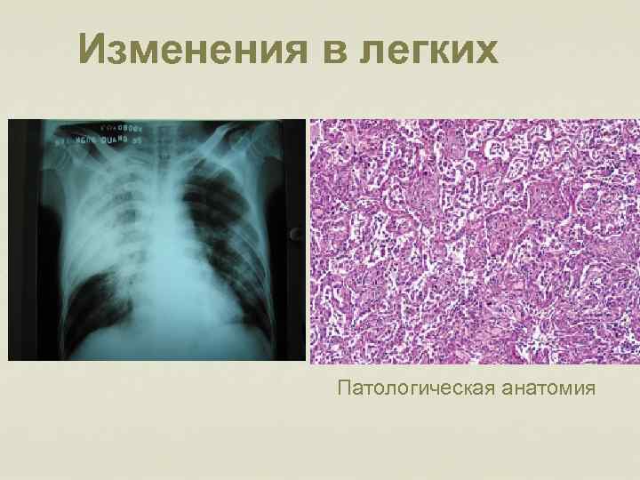 Грипп патологическая анатомия презентация