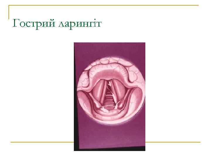 Гострий ларингіт 