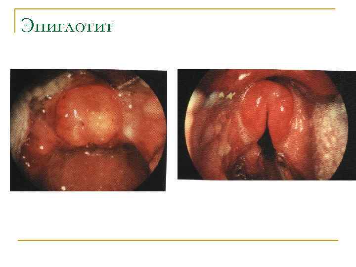 Эпиглотит 