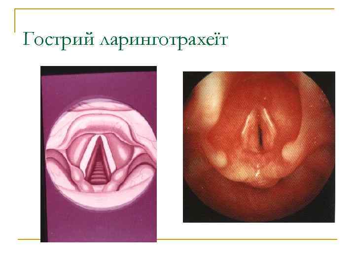 Гострий ларинготрахеїт 