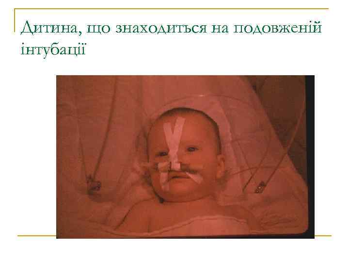 Дитина, що знаходиться на подовженій інтубації 