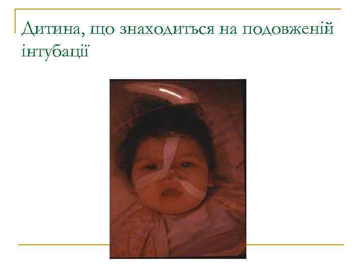 Дитина, що знаходиться на подовженій інтубації 