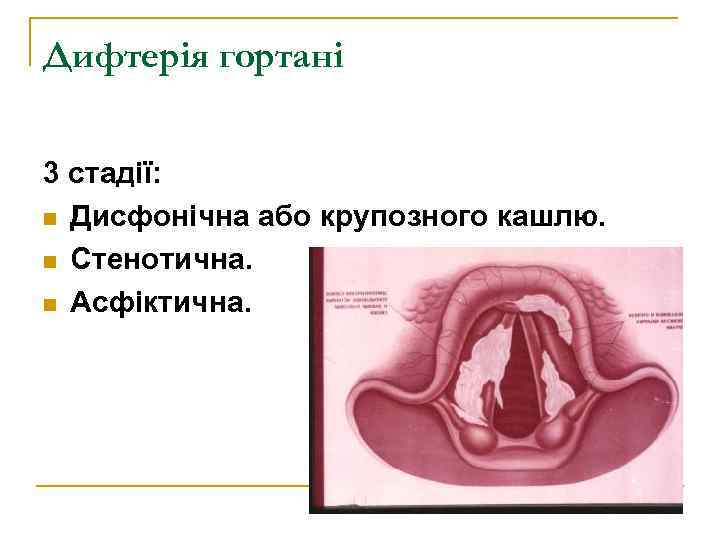 Дифтерія гортані 3 стадії: n Дисфонічна або крупозного кашлю. n Стенотична. n Асфіктична. 