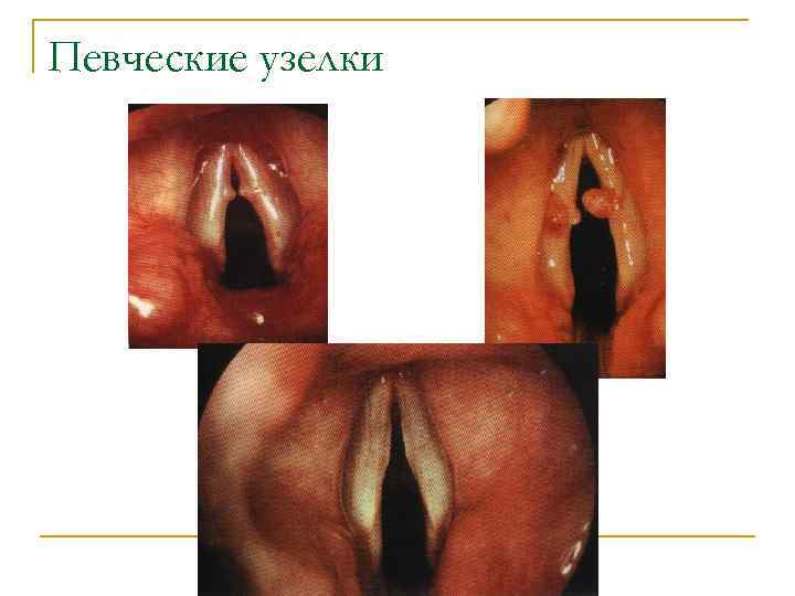 Певческие узелки 