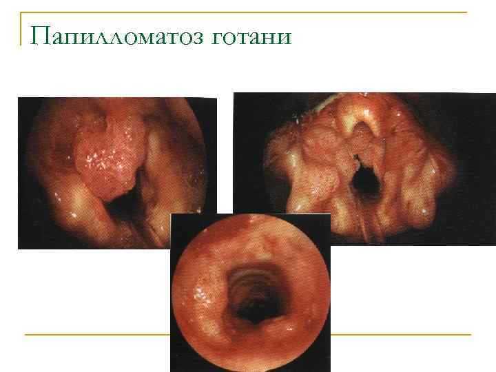 Папилломатоз готани 