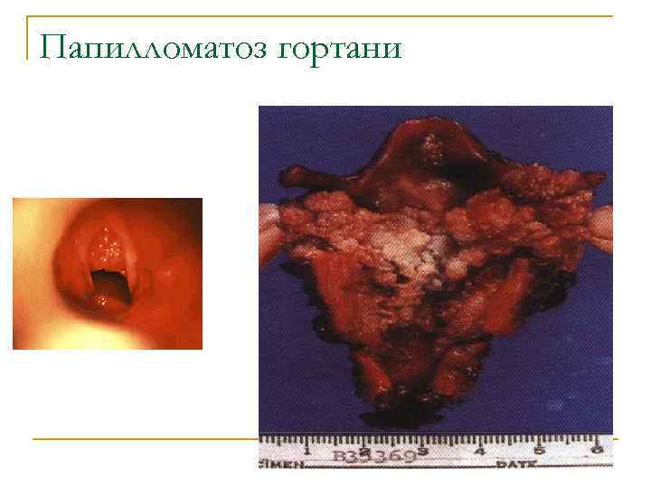 Папилломатоз гортани 