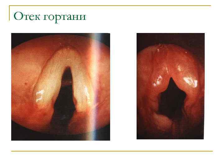 Отек гортани 