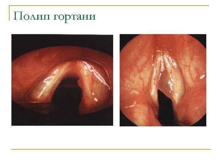 Полип гортани 