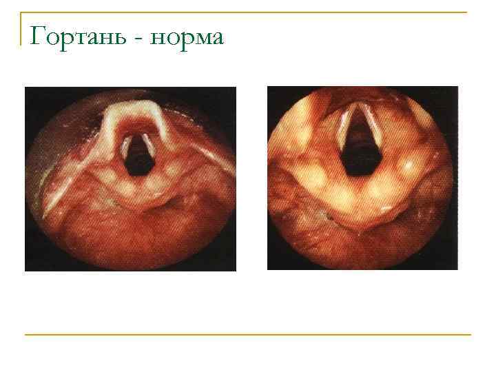 Гортань - норма 