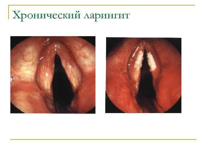 Хронический ларингит 