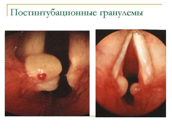 Постинтубационные гранулемы 