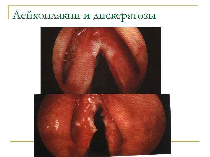 Лейкоплакии и дискератозы 