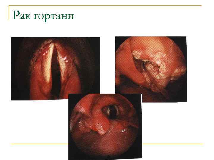 Рак гортани 