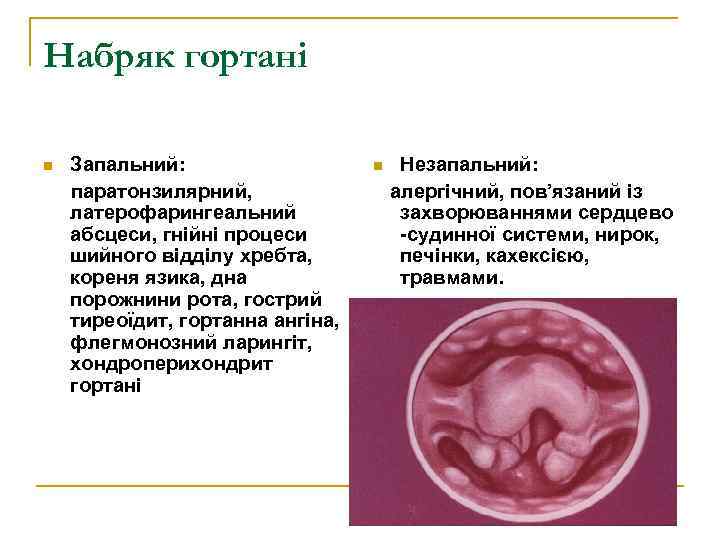 Набряк гортані n Запальний: паратонзилярний, латерофарингеальний абсцеси, гнійні процеси шийного відділу хребта, кореня язика,