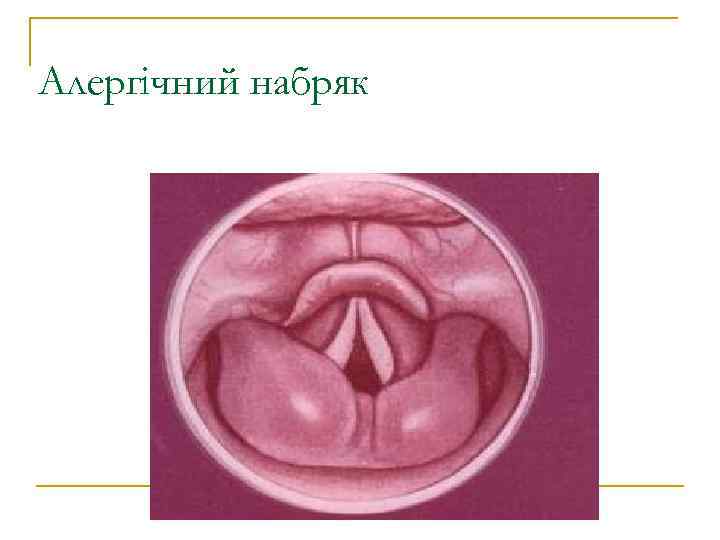 Алергічний набряк 