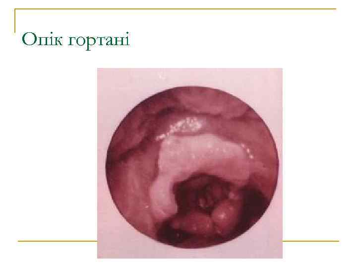 Опік гортані 