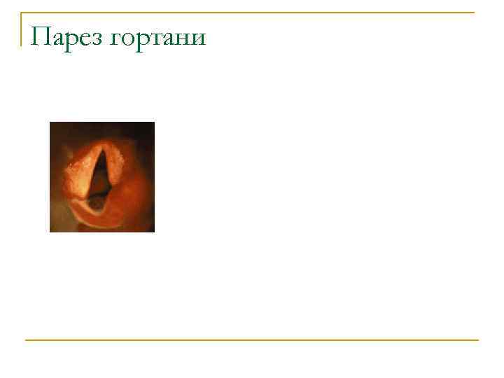 Парез гортани 