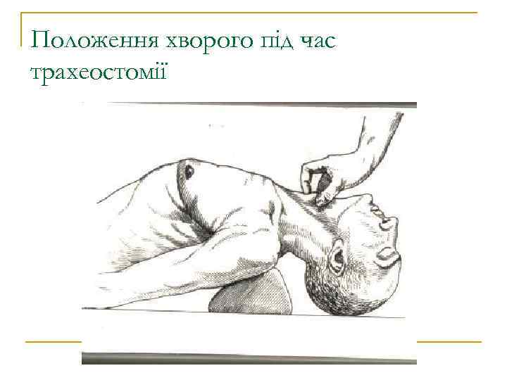 Положення хворого під час трахеостомії 