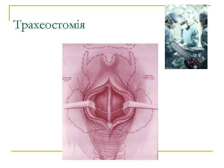 Трахеостомія 