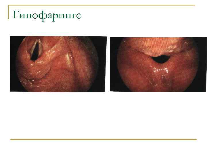 Гипофарингс 