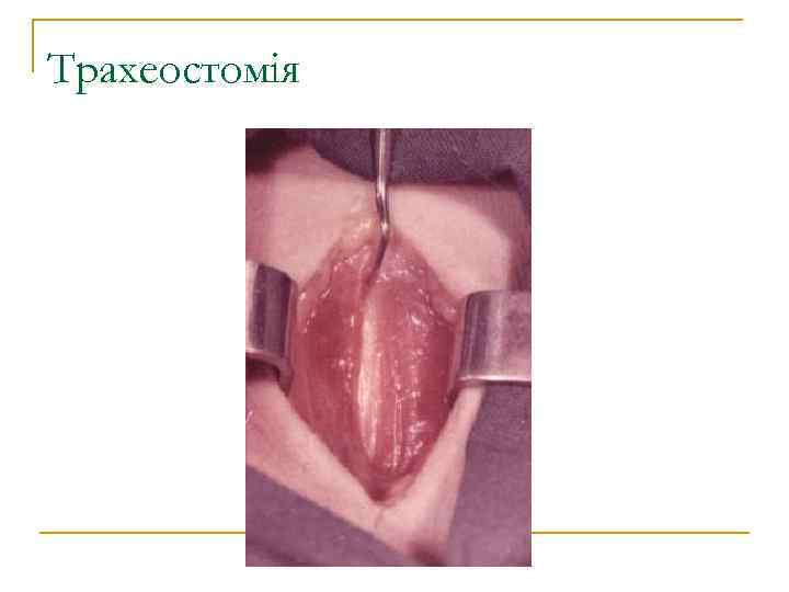 Трахеостомія 