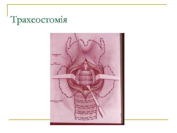 Трахеостомія 
