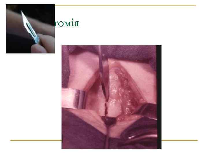 Трахеостомія 