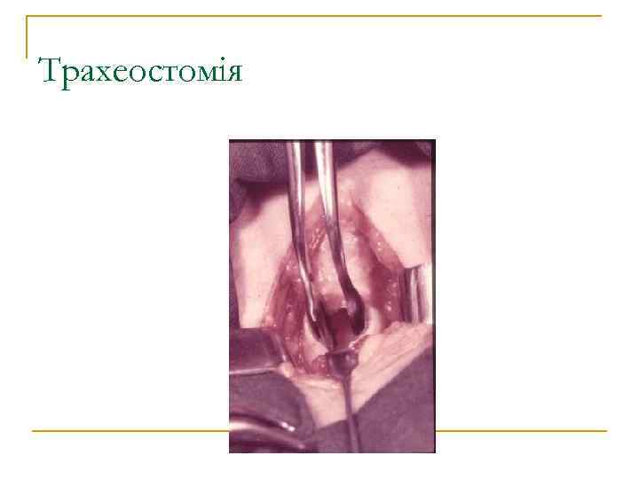 Трахеостомія 