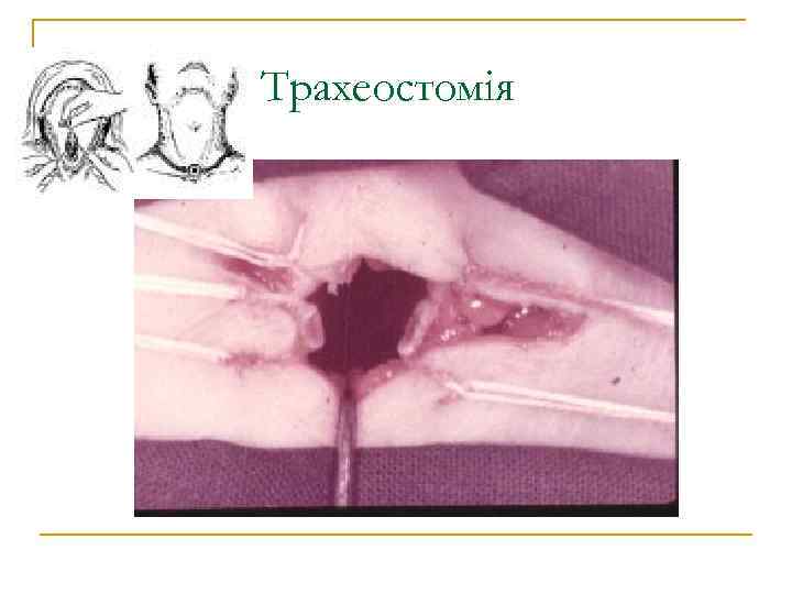 Трахеостомія 