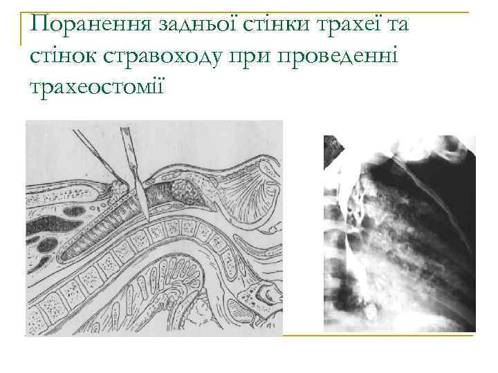 Поранення задньої стінки трахеї та стінок стравоходу при проведенні трахеостомії 
