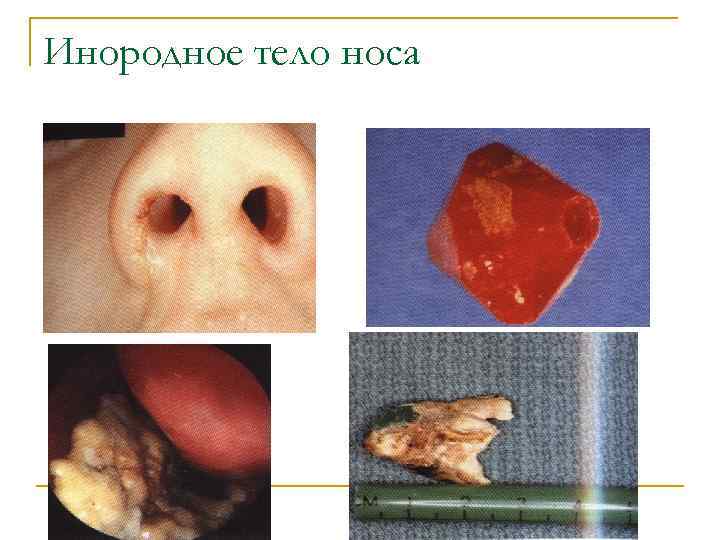 Инородное тело носа 