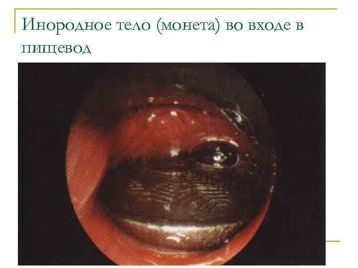 Инородное тело (монета) во входе в пищевод 