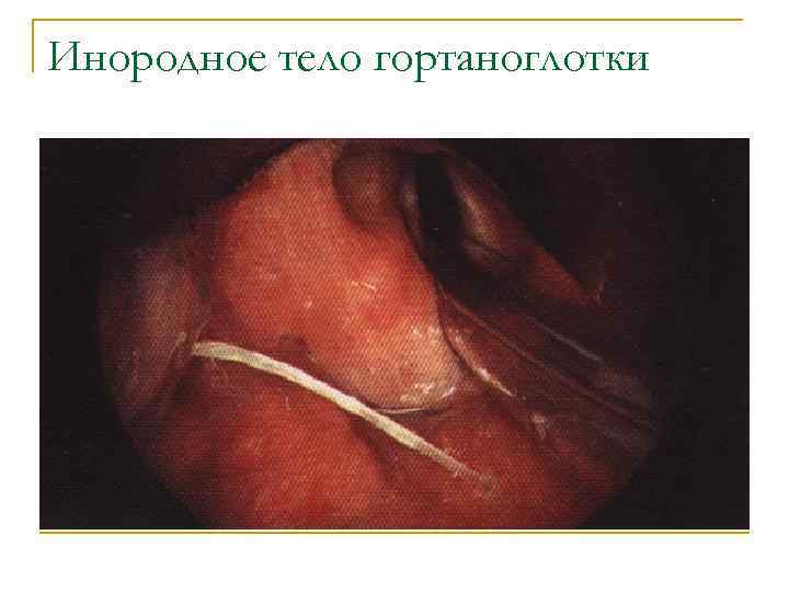 Инородное тело гортаноглотки 