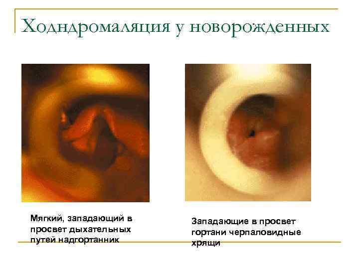 Ходндромаляция у новорожденных Мягкий, западающий в просвет дыхательных путей надгортанник Западающие в просвет гортани