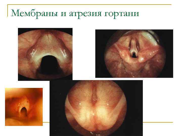 Мембраны и атрезия гортани 