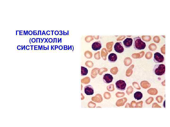 ГЕМОБЛАСТОЗЫ (ОПУХОЛИ СИСТЕМЫ КРОВИ) 