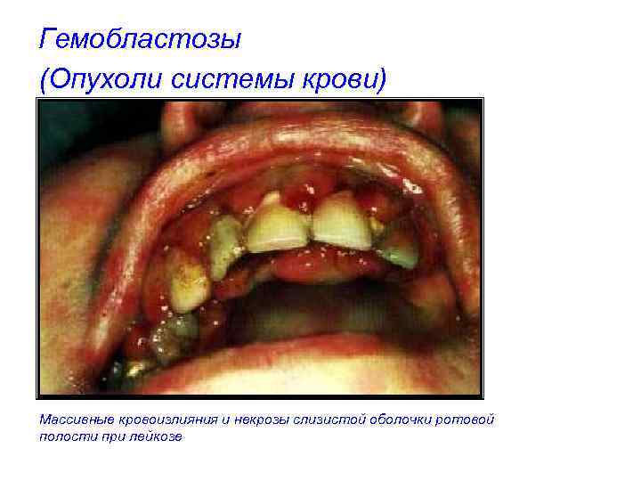 Гемобластозы (Опухоли системы крови) Массивные кровоизлияния и некрозы слизистой оболочки ротовой полости при лейкозе