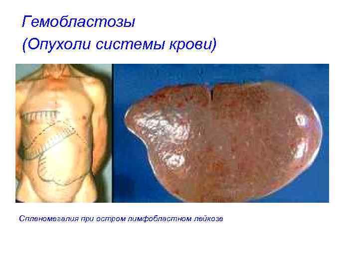 Гемобластозы (Опухоли системы крови) Спленомегалия при остром лимфобластном лейкозе 