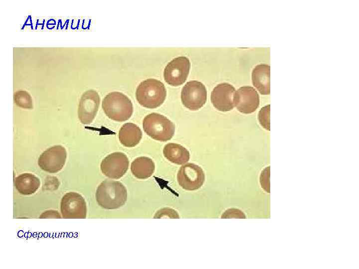 Анемии Сфероцитоз 