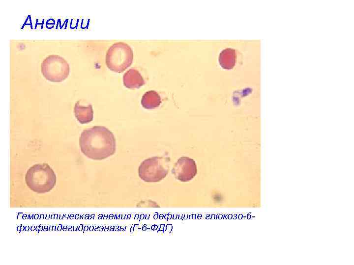 Анемии Гемолитическая анемия при дефиците глюкозо-6 фосфатдегидрогэназы (Г-6 -ФДГ) 