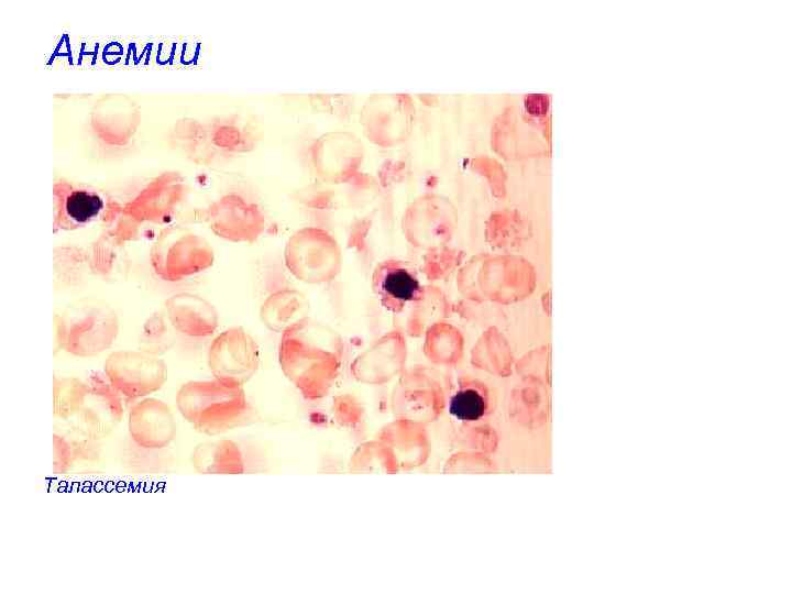 Анемии Талассемия 