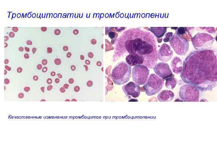 Тромбоцитопатии и тромбоцитопении Качественные изменения тромбоцитов при тромбоцитопении 